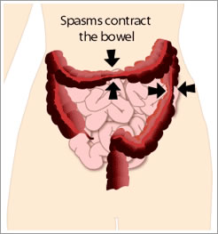 intestinal spasms