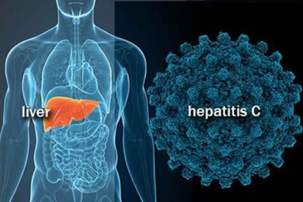 hepatitis