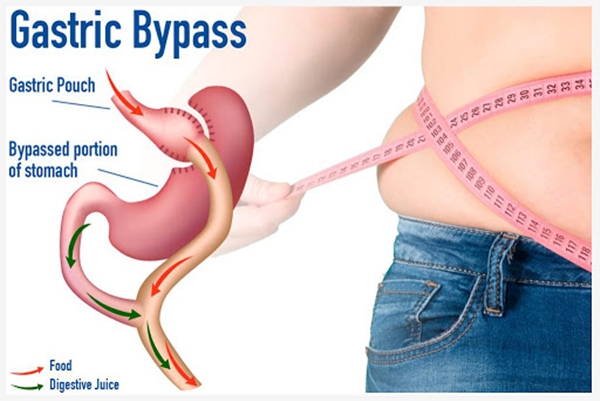 Gastric Bypass